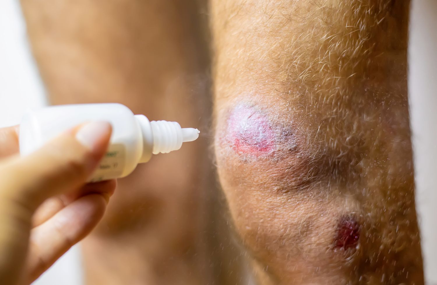 Moist Wound Healing